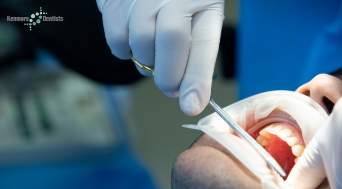 How to Prepare for a Surgical Extraction Of Tooth?