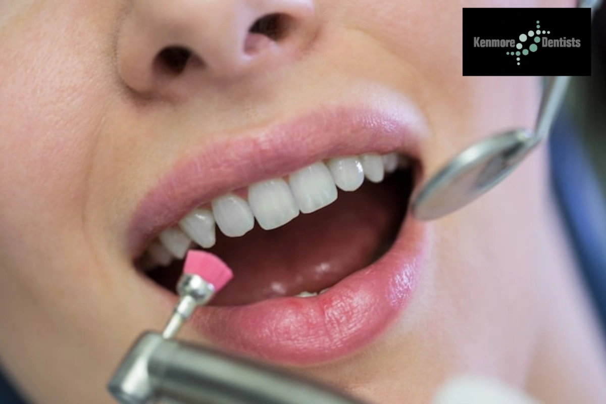 How to Determine That You Need Composite Veneers?